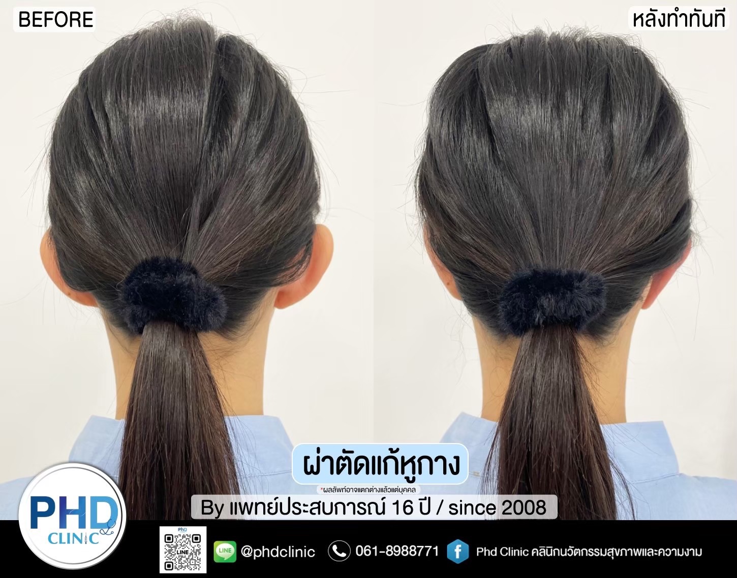 แก้หูกาง