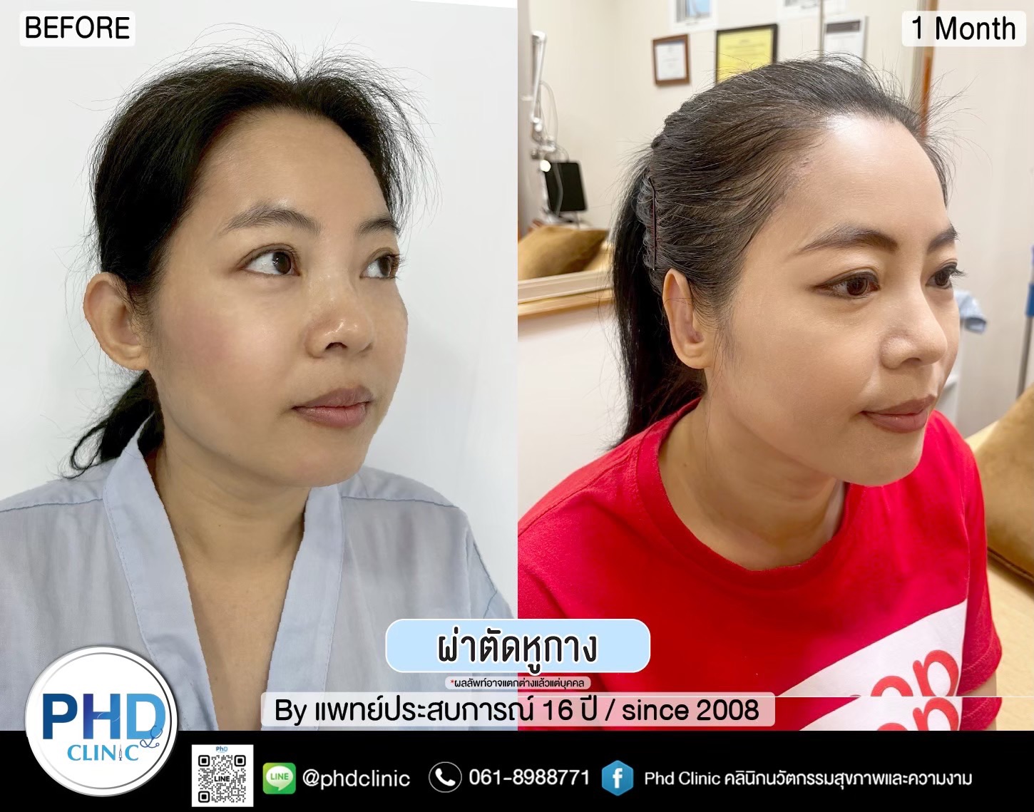 ผ่าตัดแก้หูกางพัทยา