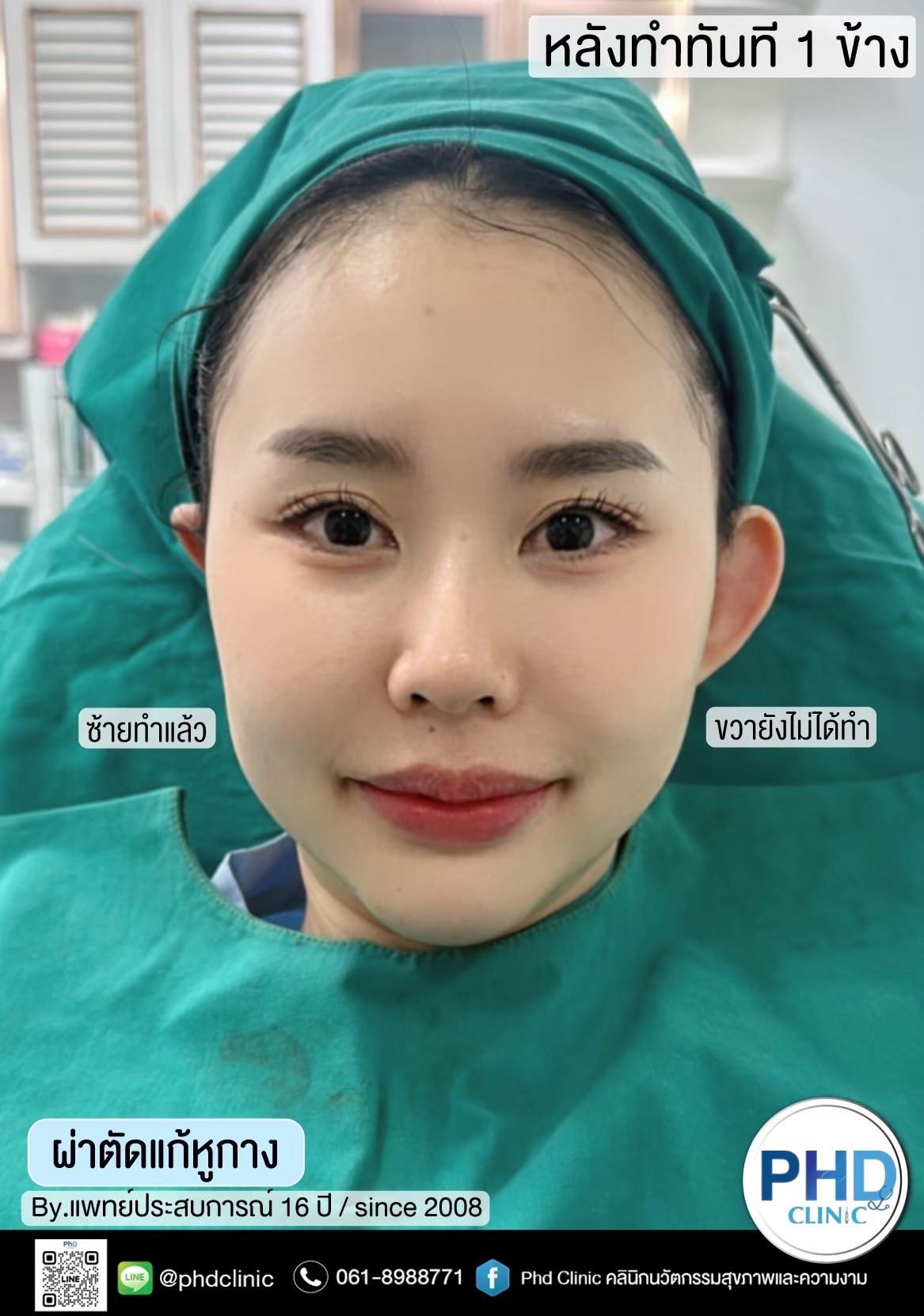 แก้หูกาง
