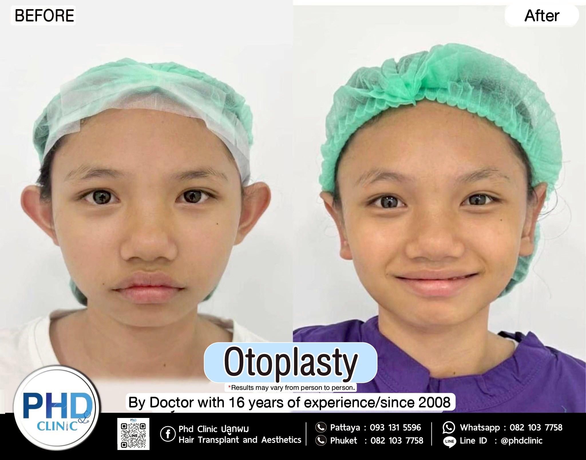 Otoplasty pattaya