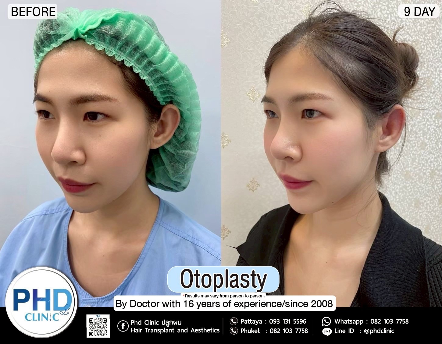 Otoplasty Phuket