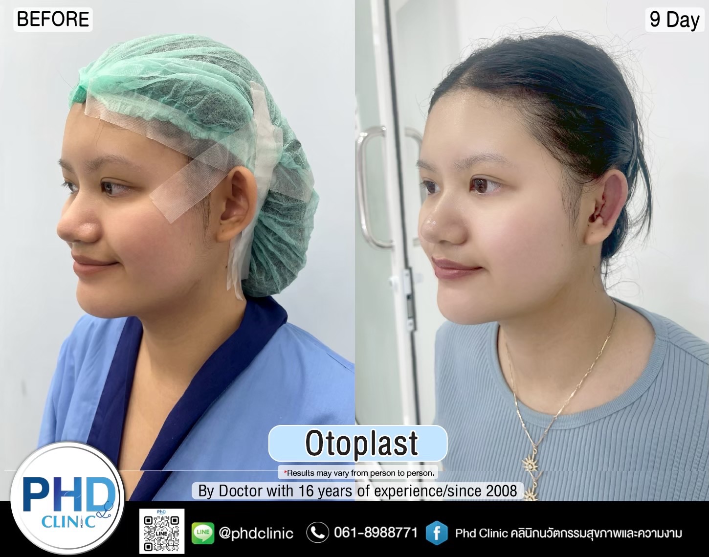 Otoplasty Phuket