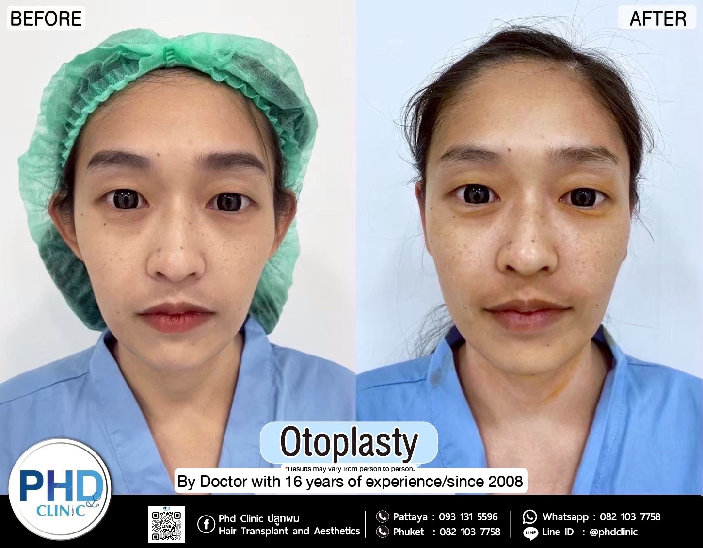Otoplasty Phuket
