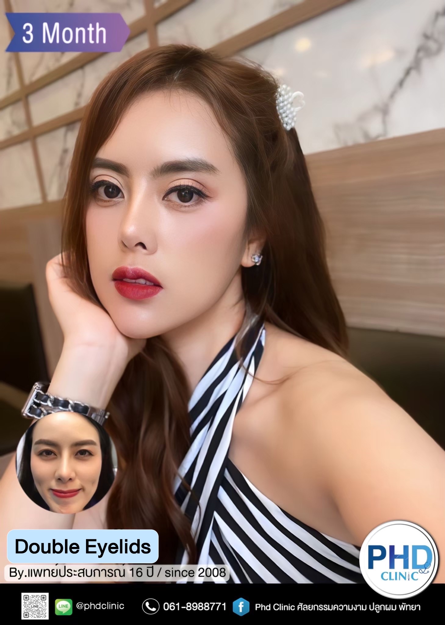 Double eyelid surgery Phuket