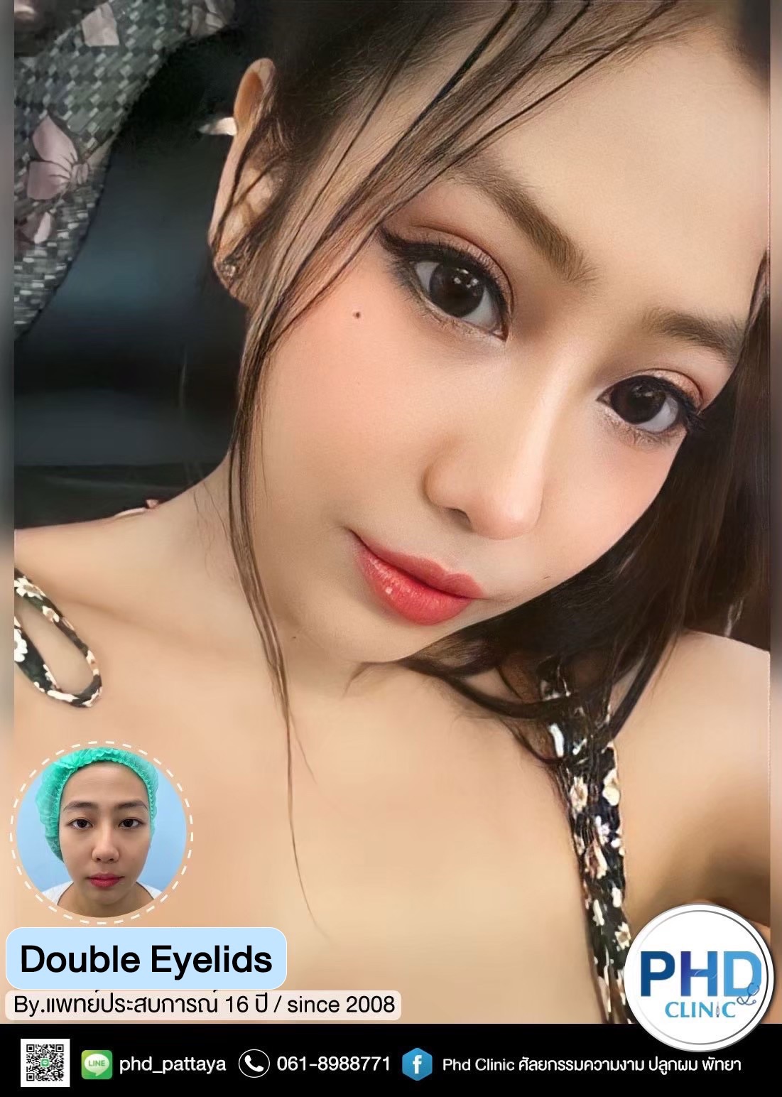 Double eyelid surgery Phuket