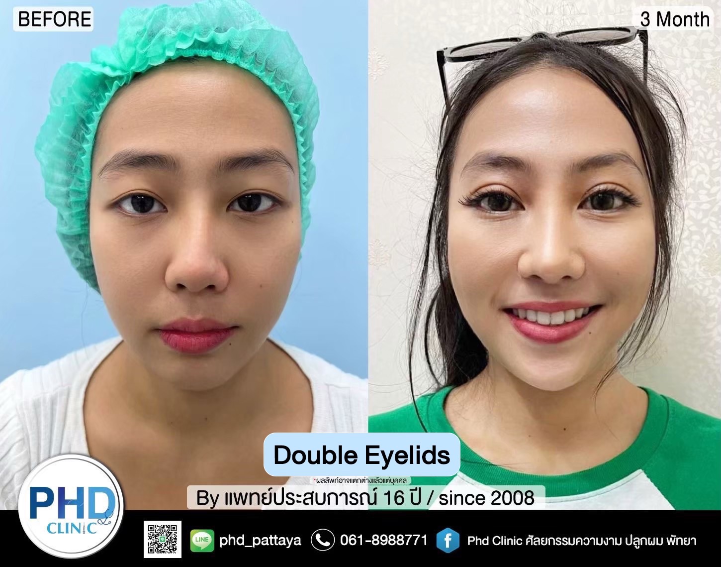 Double eyelid surgery Phuket