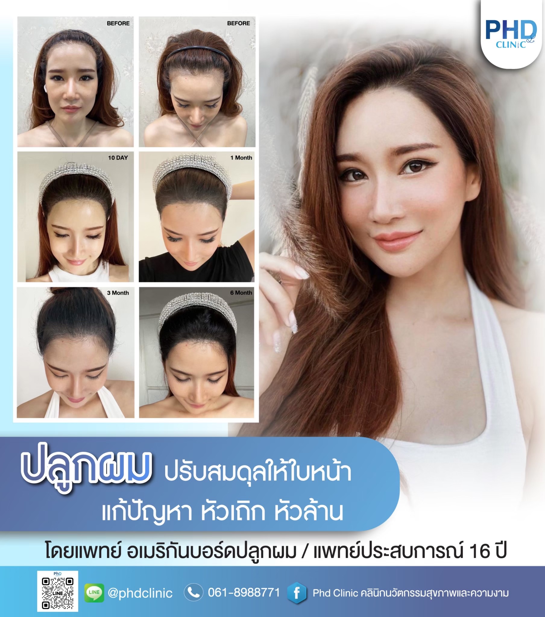 แพทย์อเมริกันบอร์ดปลูกผม