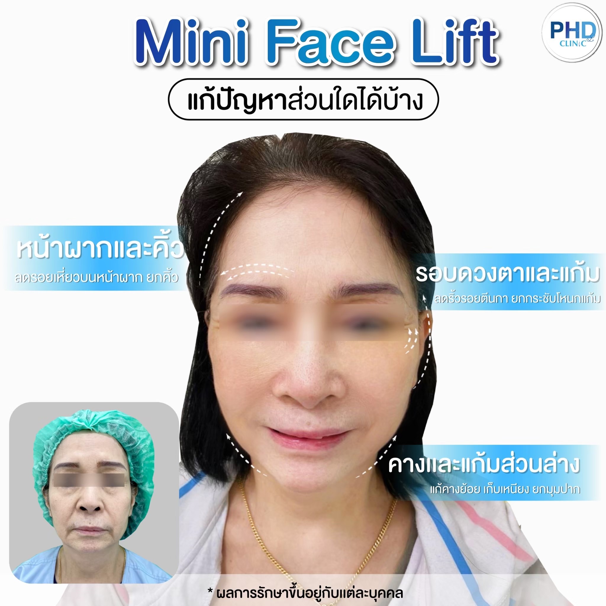 ดึงหน้า