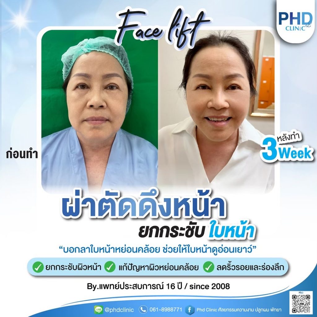 ผ่าตัดดึงหน้ากรุงเทพ