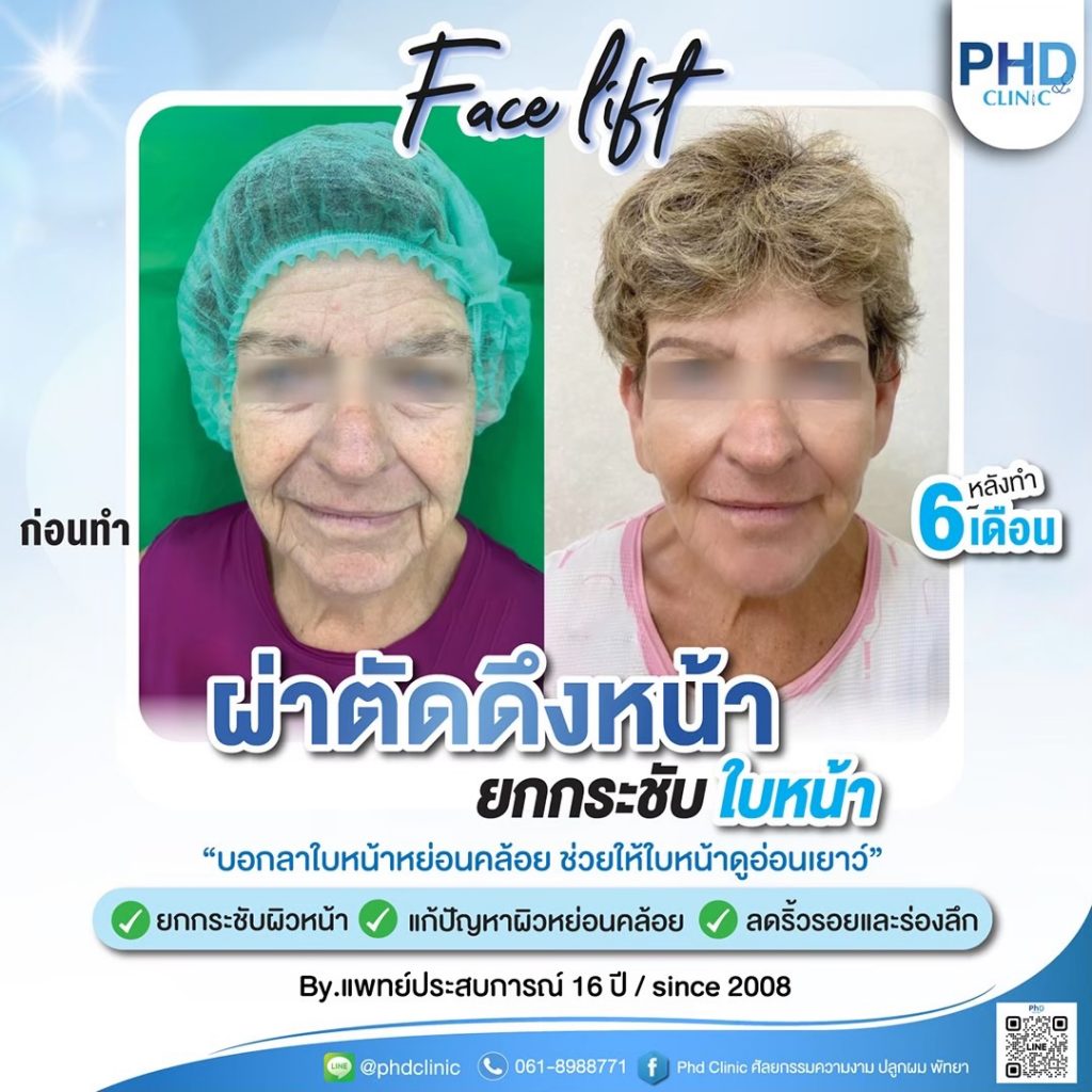 ผ่าตัดดึงหน้ากรุงเทพ