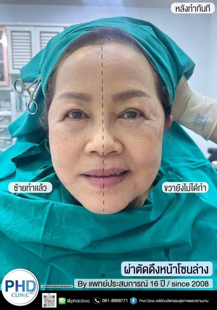 ผ่าตัดดึงหน้ากรุงเทพ