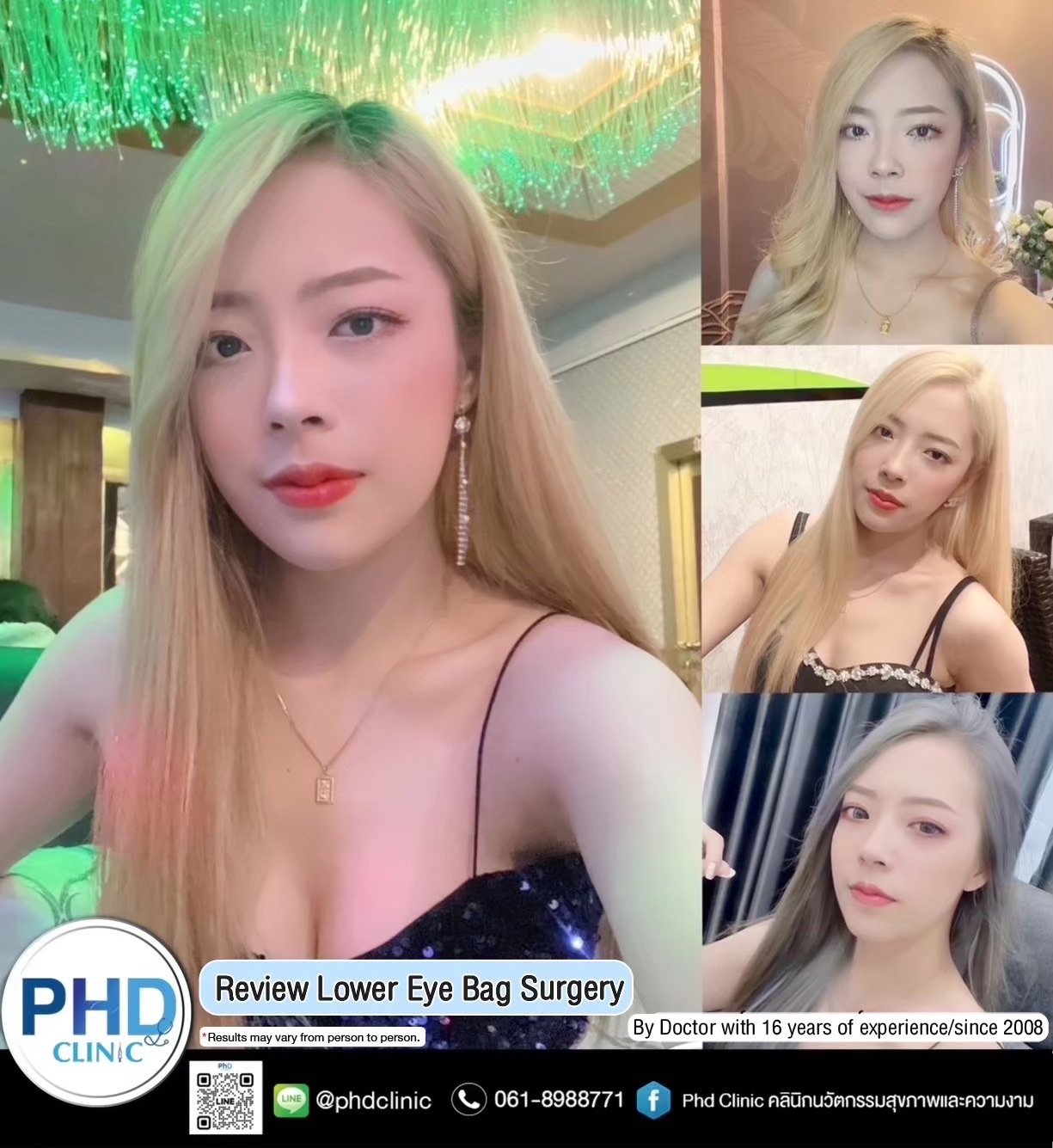 Lower eyebag surgery "internal incision" vs. "external incision"